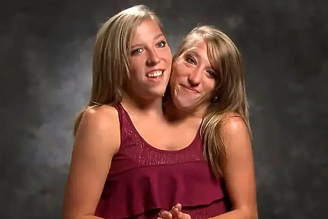 Историята на сиамските близначки Аби и Британи Хензел, които родиха и имат дете